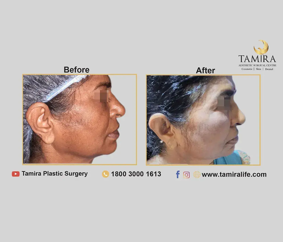Invasive Radio Frequency - Inmode Facetite - Skin - Before & After