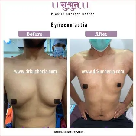 Gynecomastia Surgery