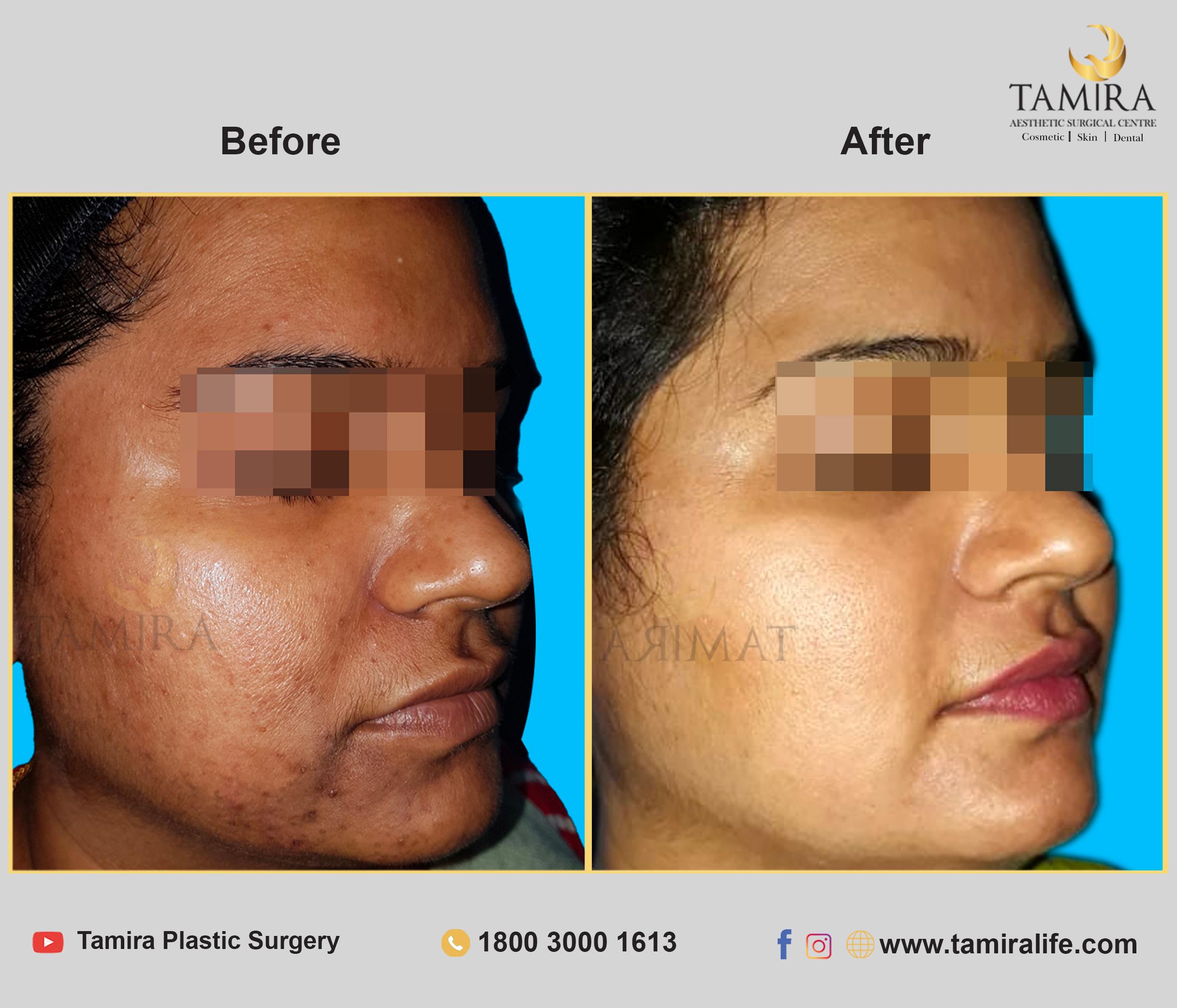 Microneedling - Before & After