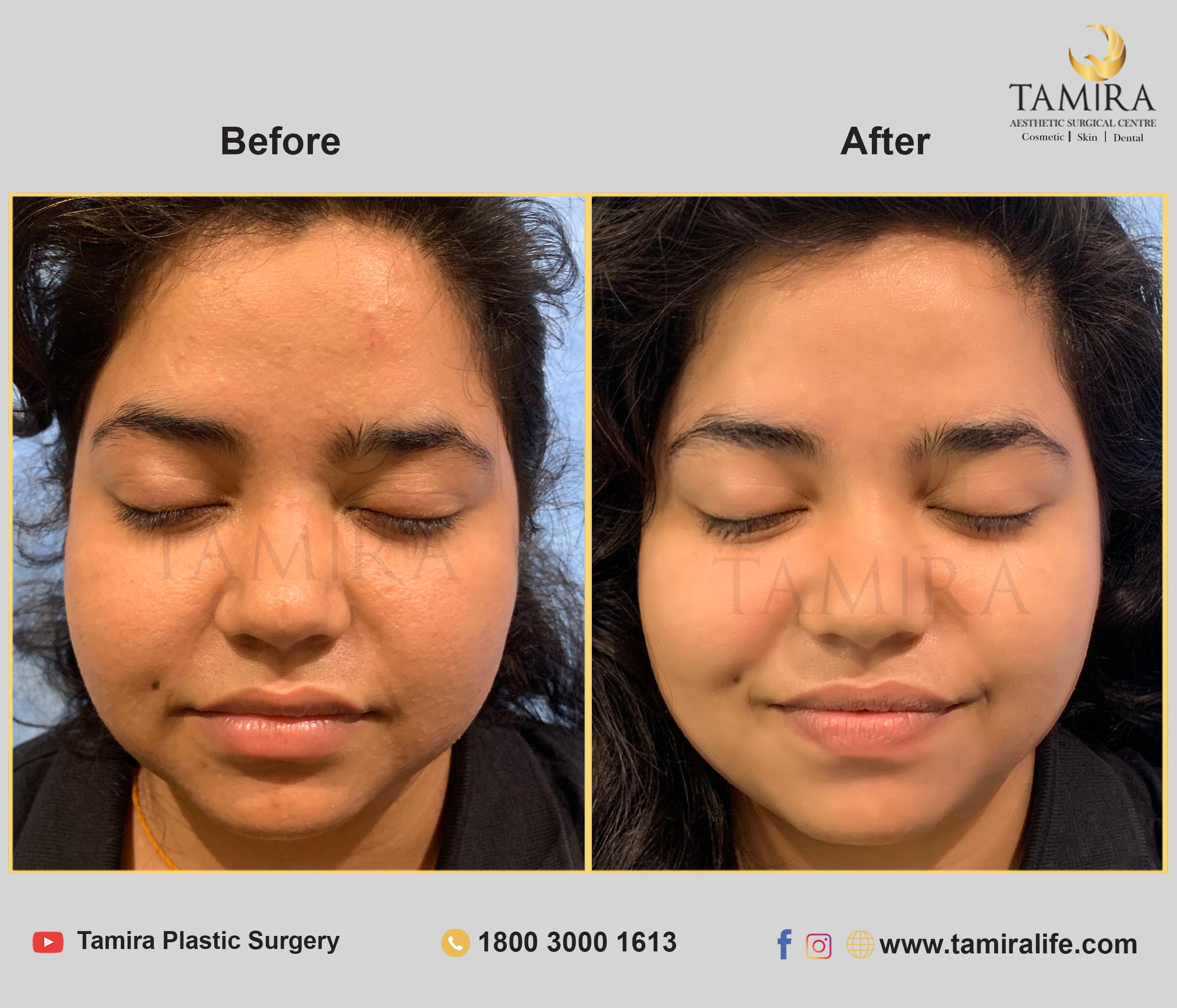 Hydra Facial - Before & After