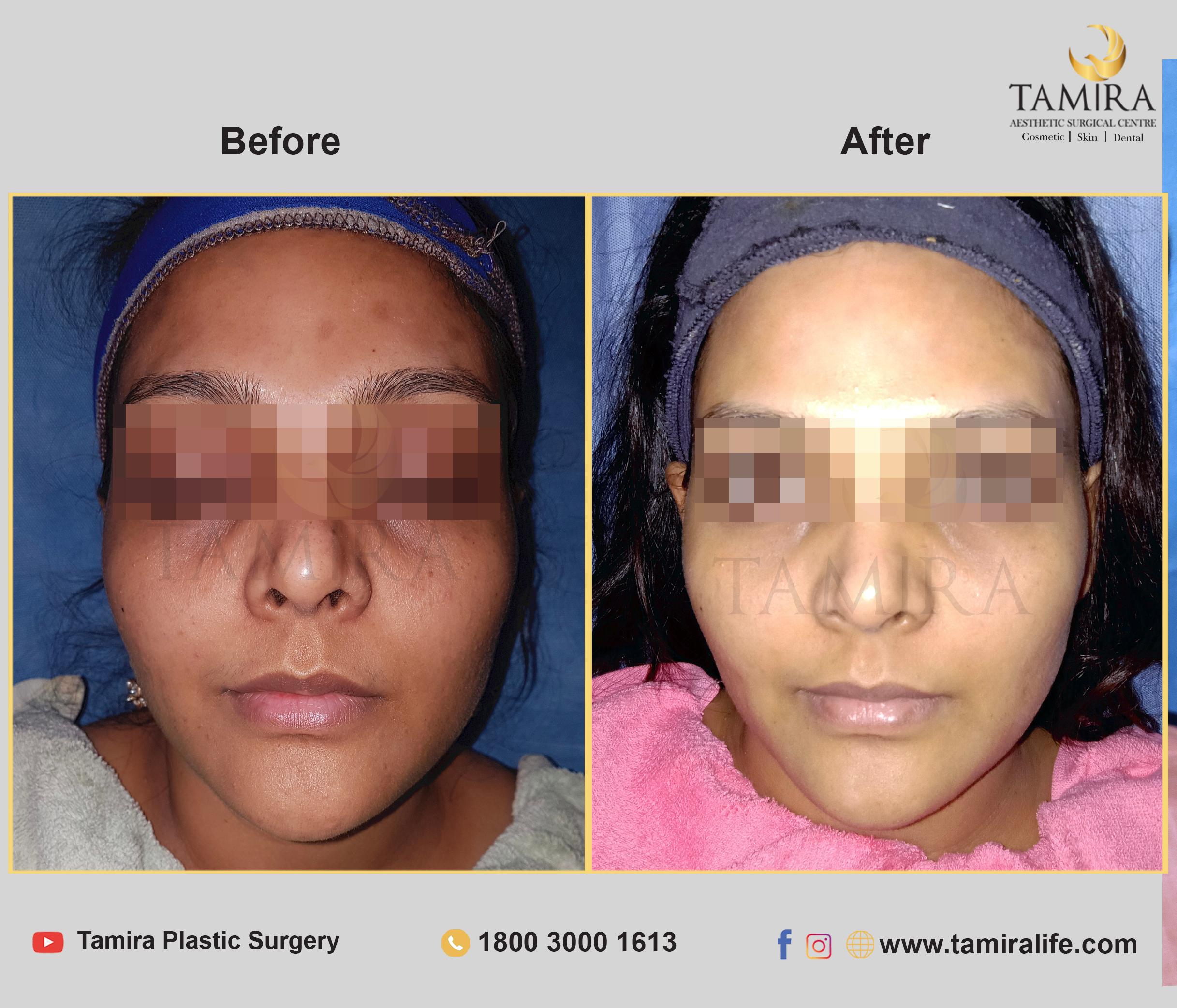 Hydra Facial - Before & After