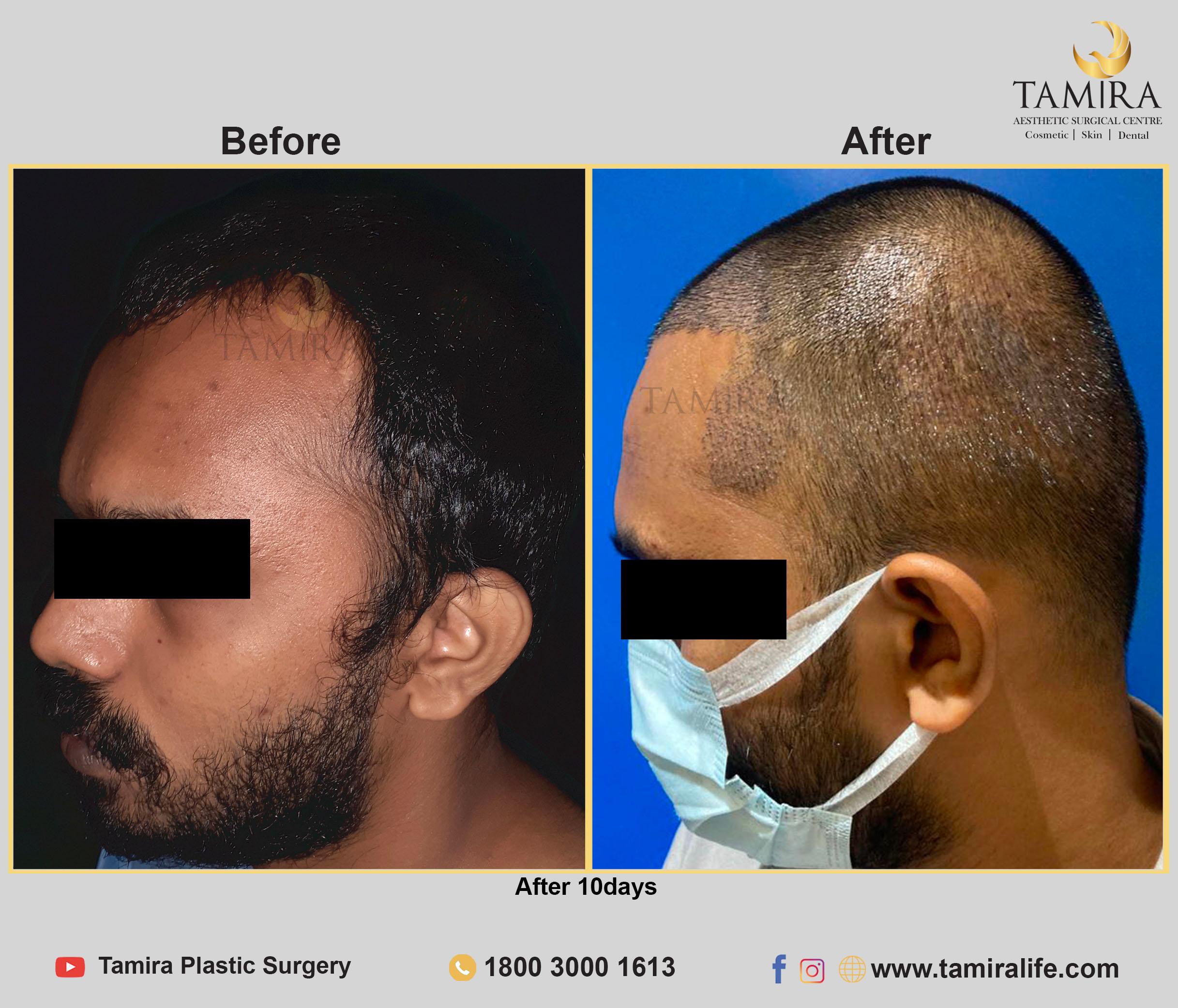 Hair Transplant - Before & After