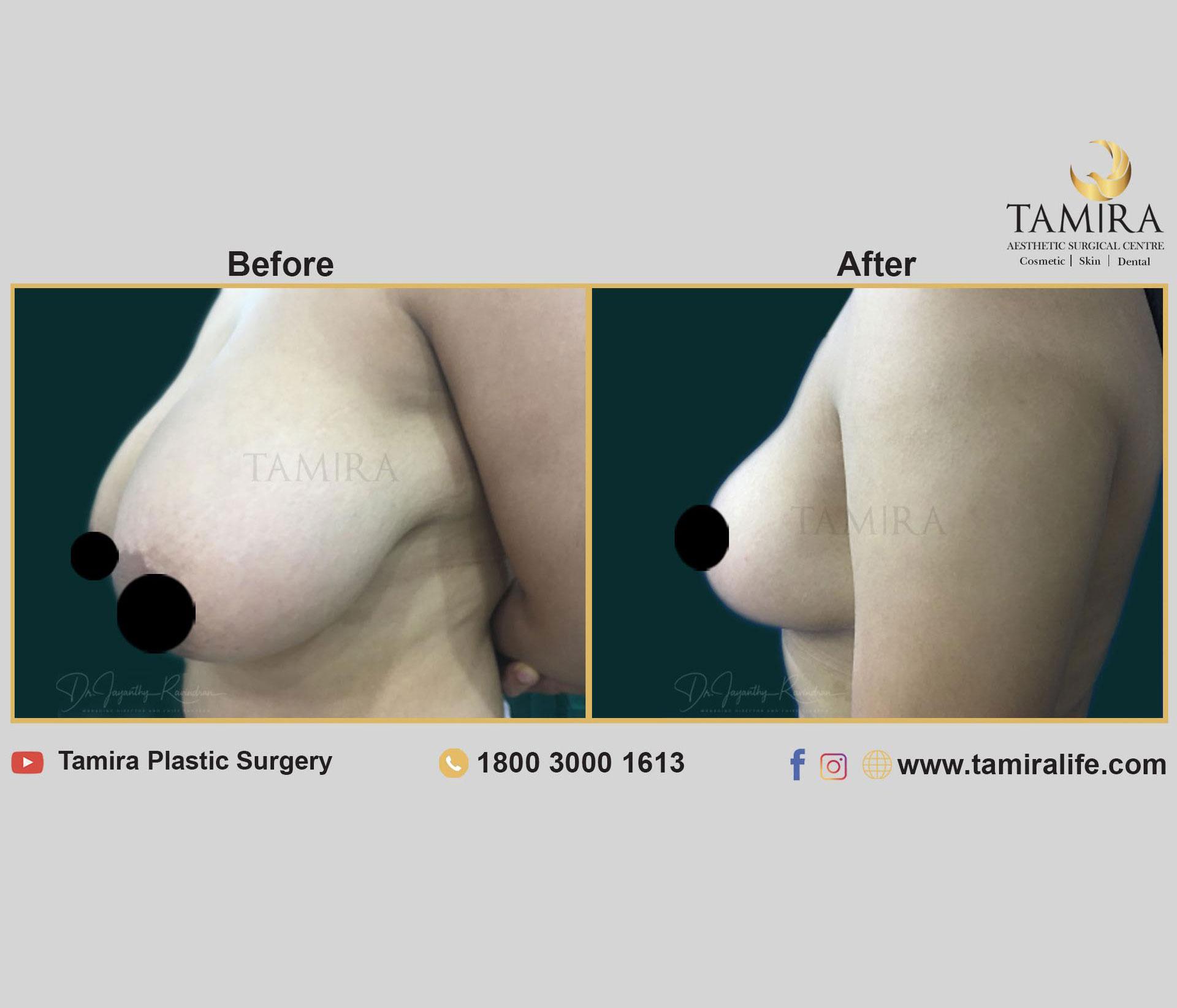 Breast Reduction Surgery or Reduction Mammoplasty - Before & After
