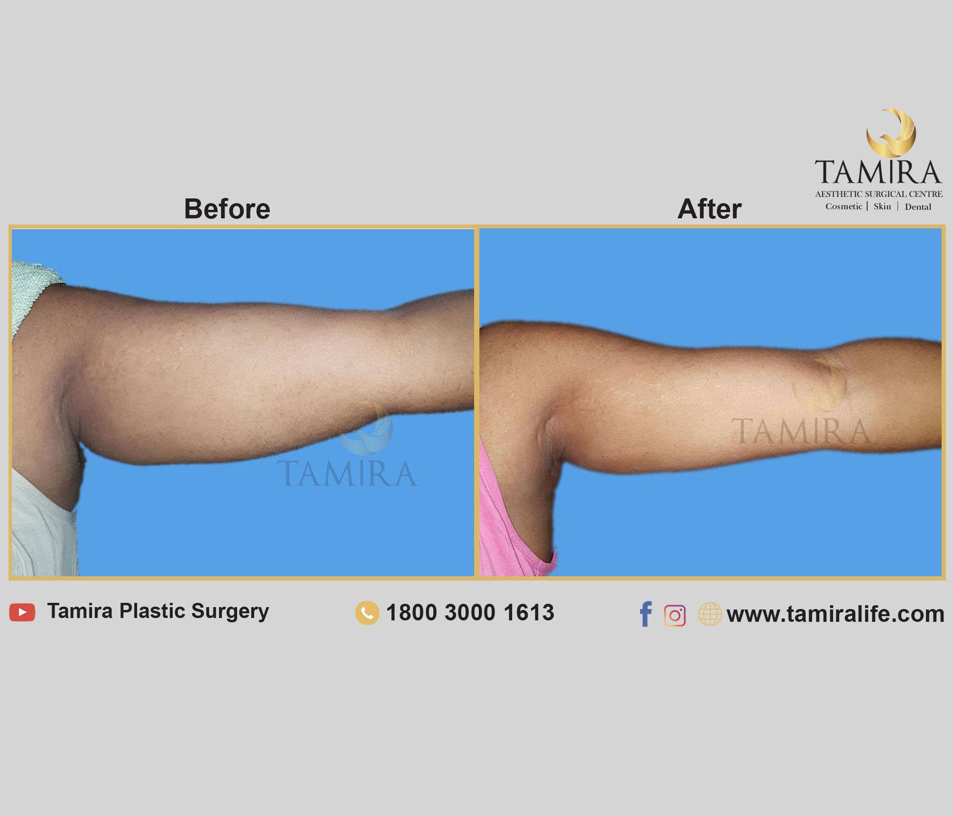 Coolsculpting - Before & After