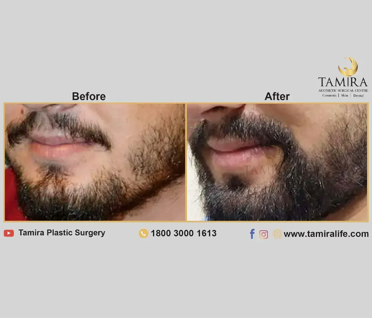 Beard Transplant - Before & After