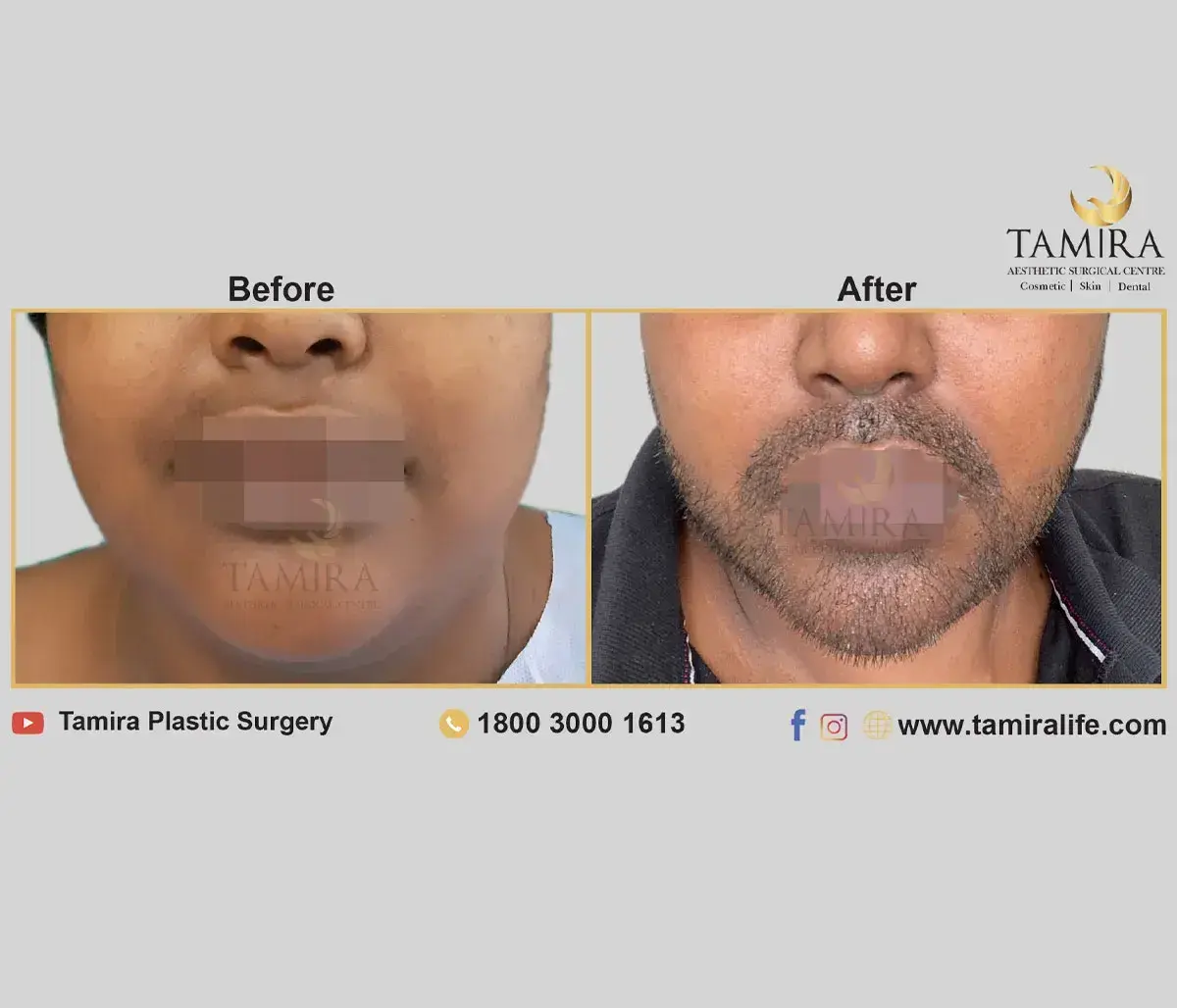 Beard Transplant - Before & After