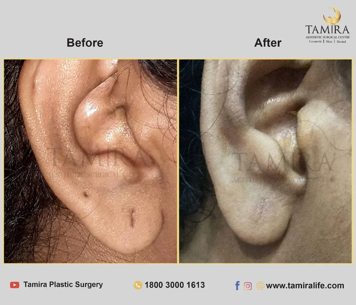 Ear Lobe Repair Surgery - Before & After