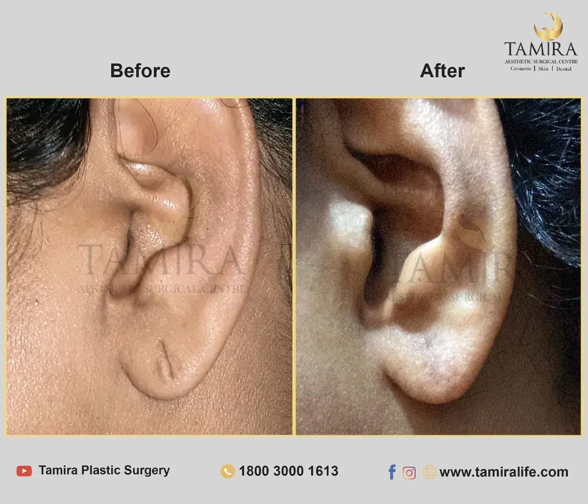 Ear Lobe Repair Surgery - Before & After