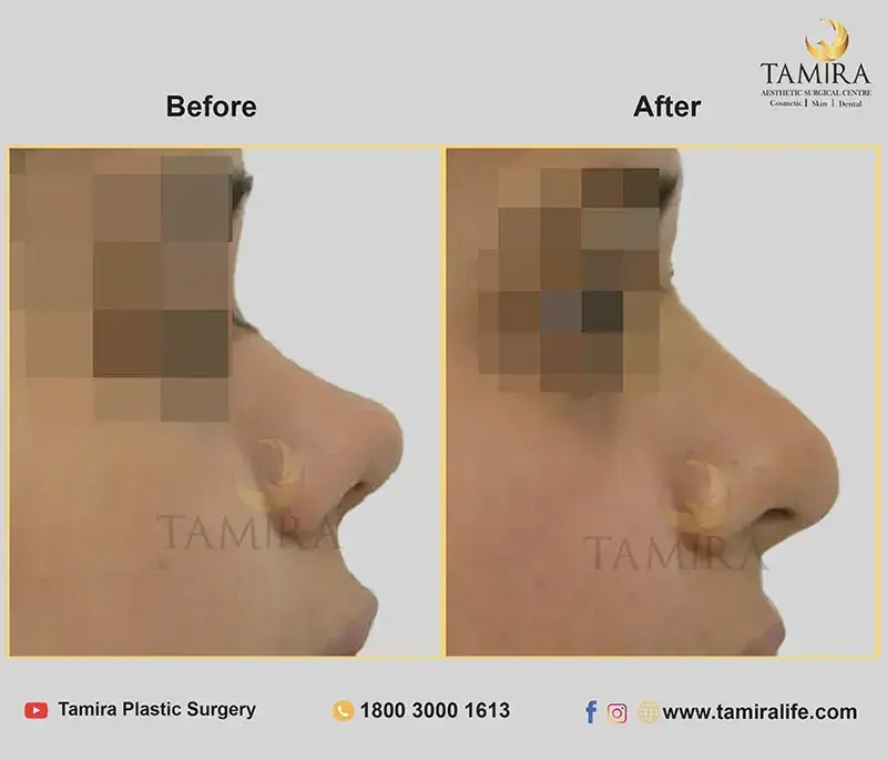 Rhinoplasty - Before & After