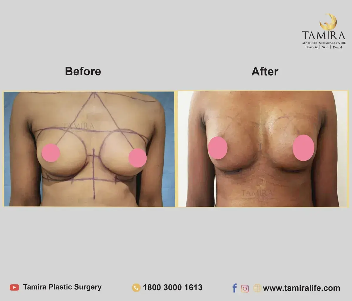 Augmentation Mastopexy - Before & After