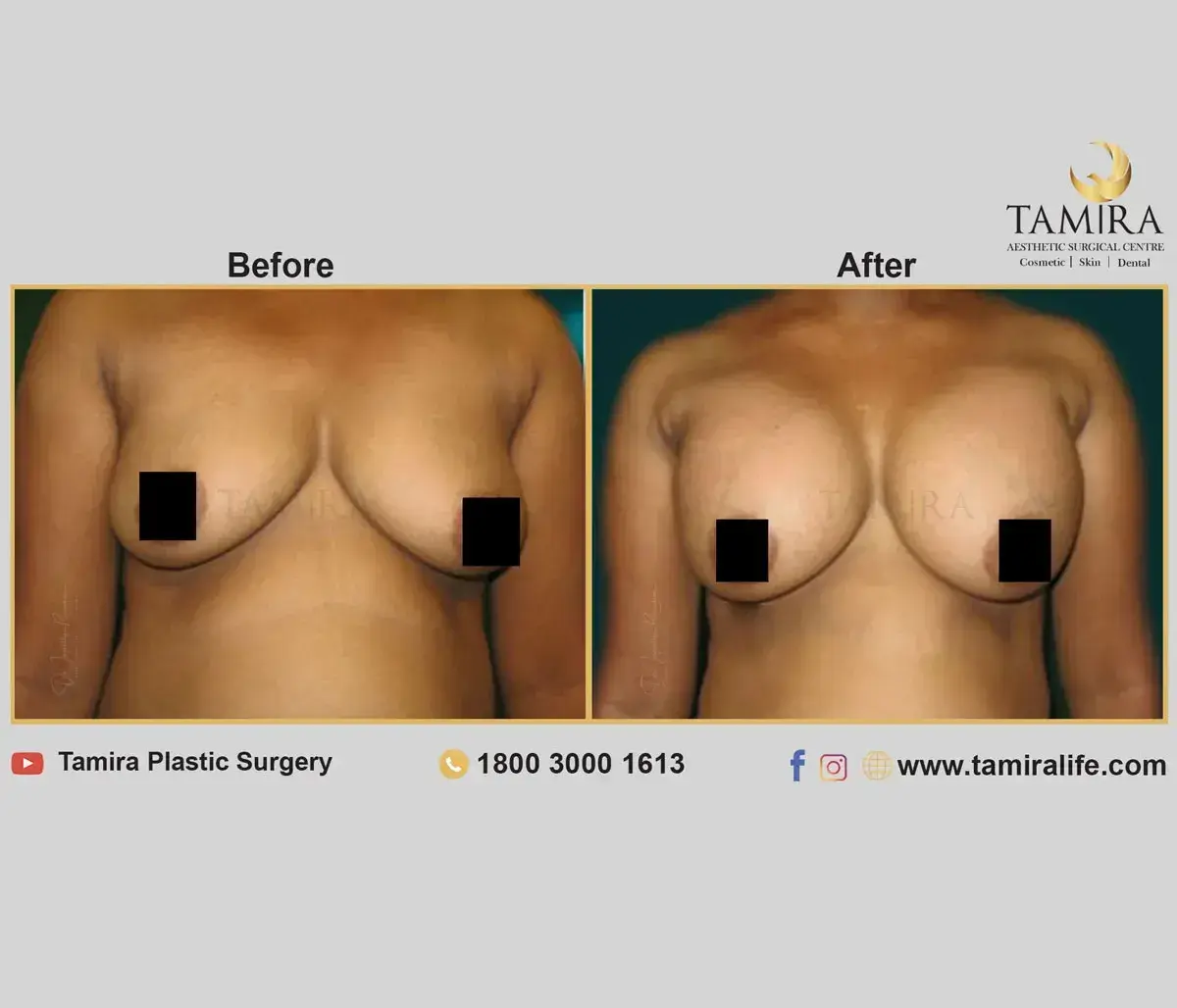 Breast Augmentation with Implants - Before & After