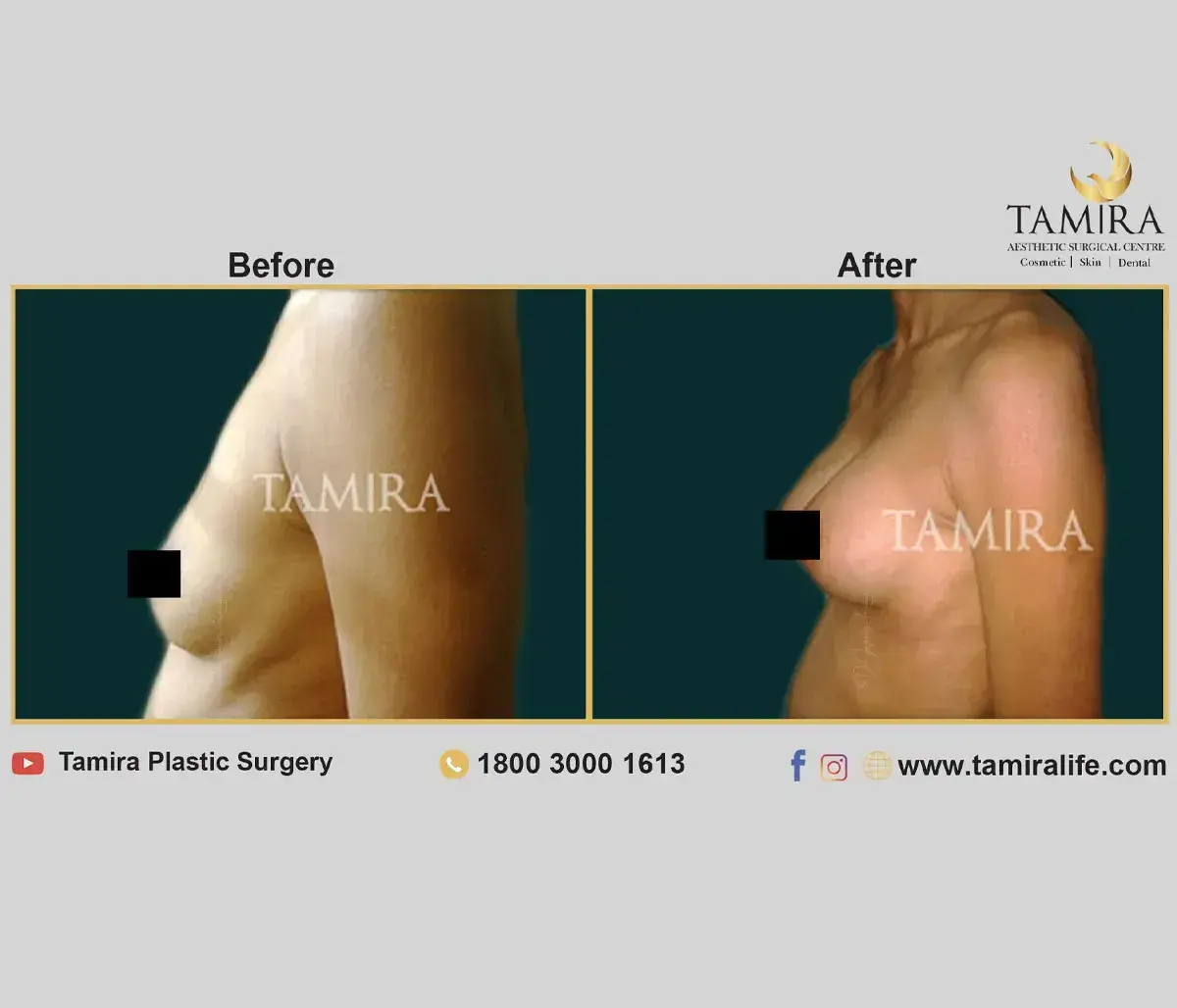 Breast Augmentation with Implants - Before & After