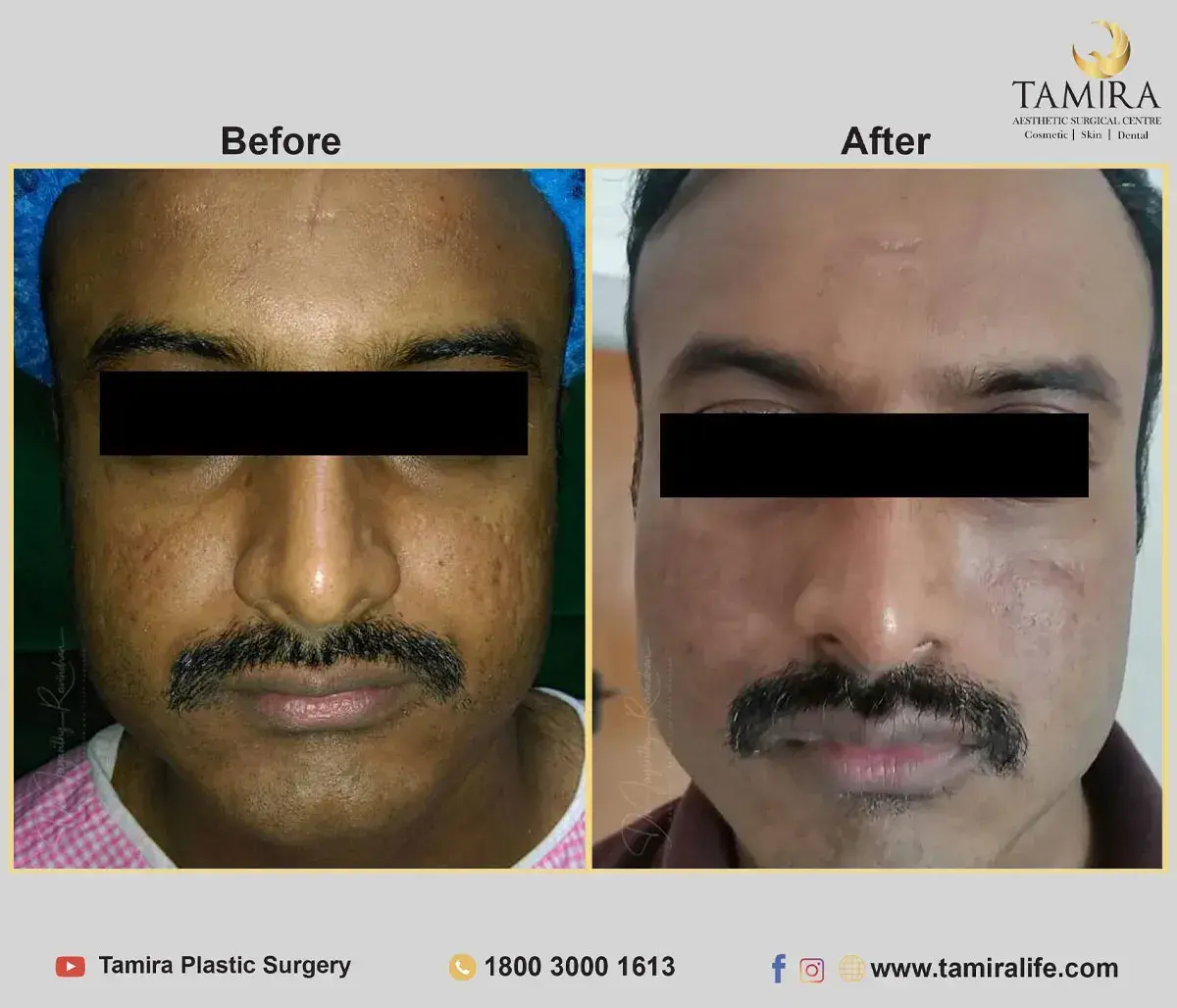 Facelift Surgery with Fat Grafting - Before & After