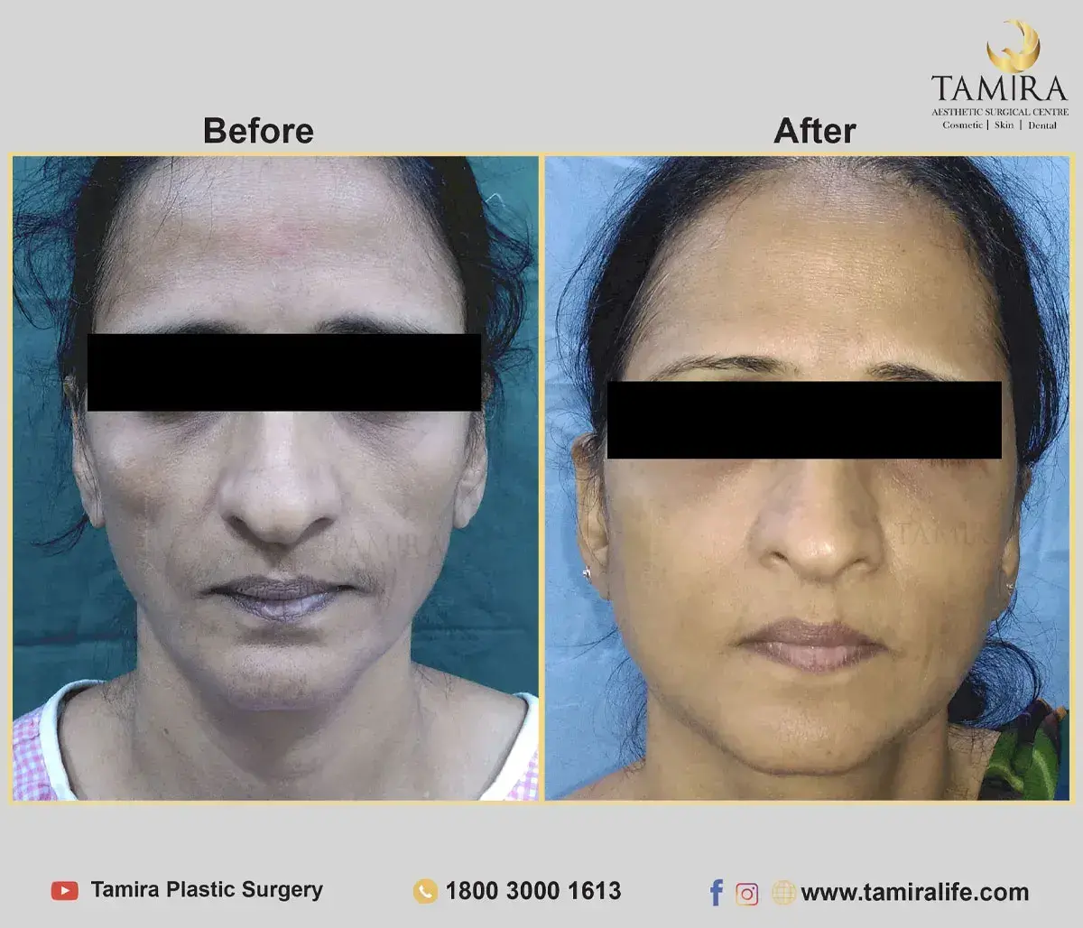 Facelift Surgery with Fat Grafting - Before & After