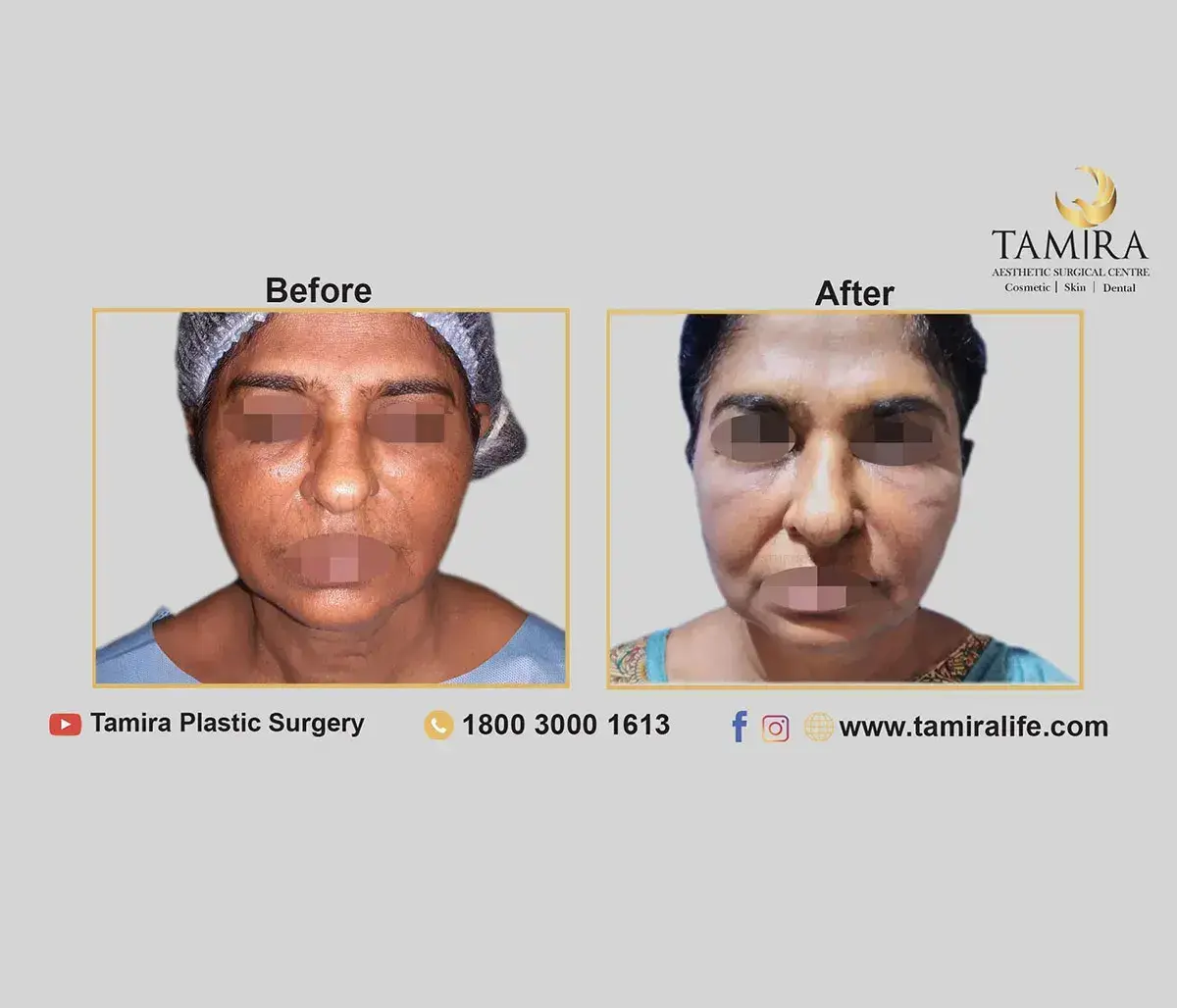 Invasive Radio Frequency - Inmode Facetite - Cheeks - Before & After