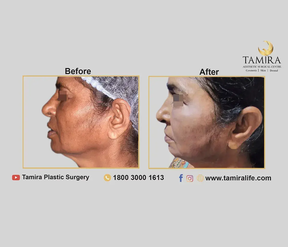 Invasive Radio Frequency - Inmode Facetite - Face - Before & After