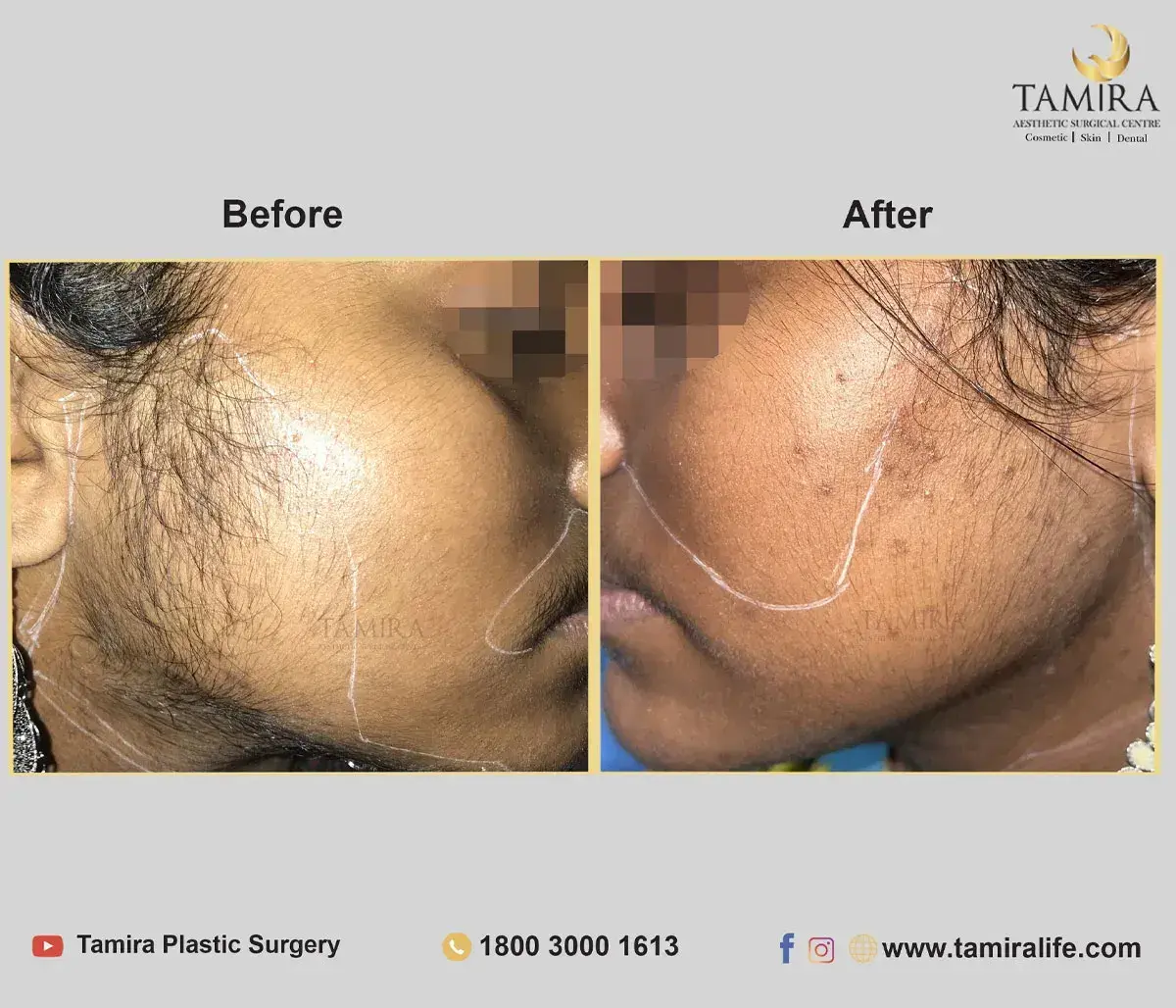 Laser Hair Removal - Skin - Before & After
