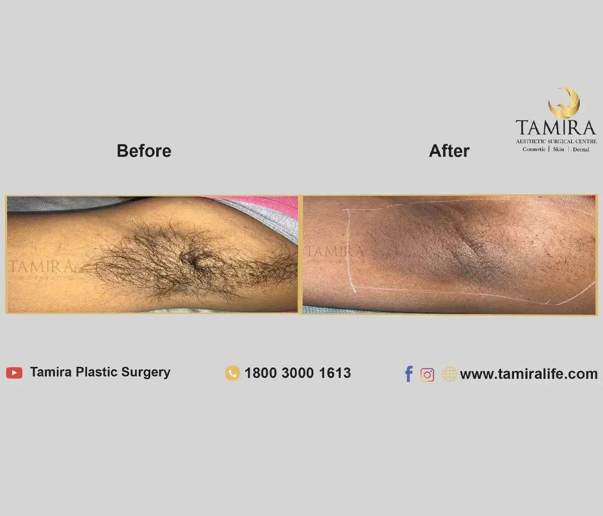 Laser Hair Removal - Skin - Before & After
