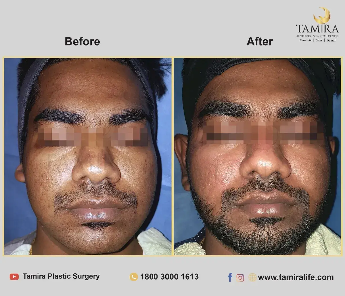 Laser treatment - Skin - Before & After