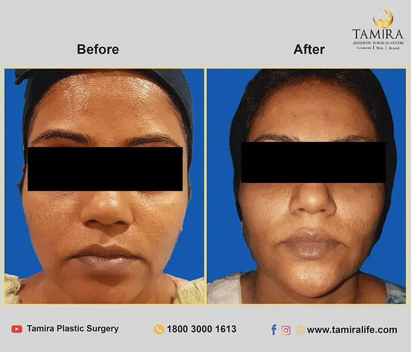 Non Invasive RF Skin tightening - Thermage - Before & After