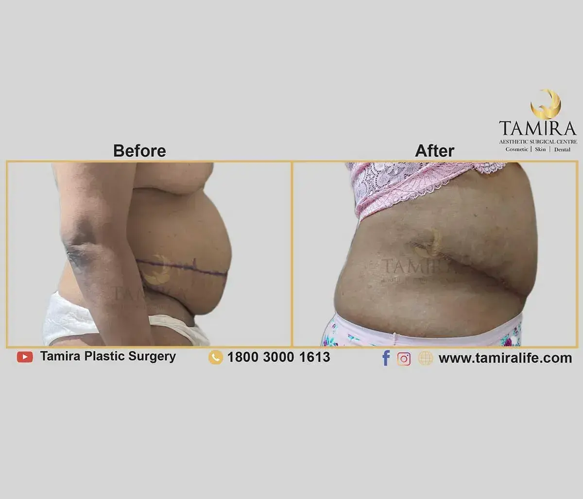 Lipo Abdominoplasty - Before & After
