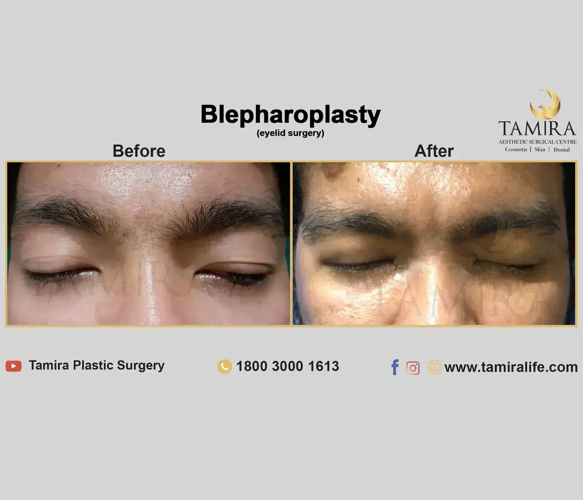 Upper eyelid blepharoplasty - Eye Brows - Before & After