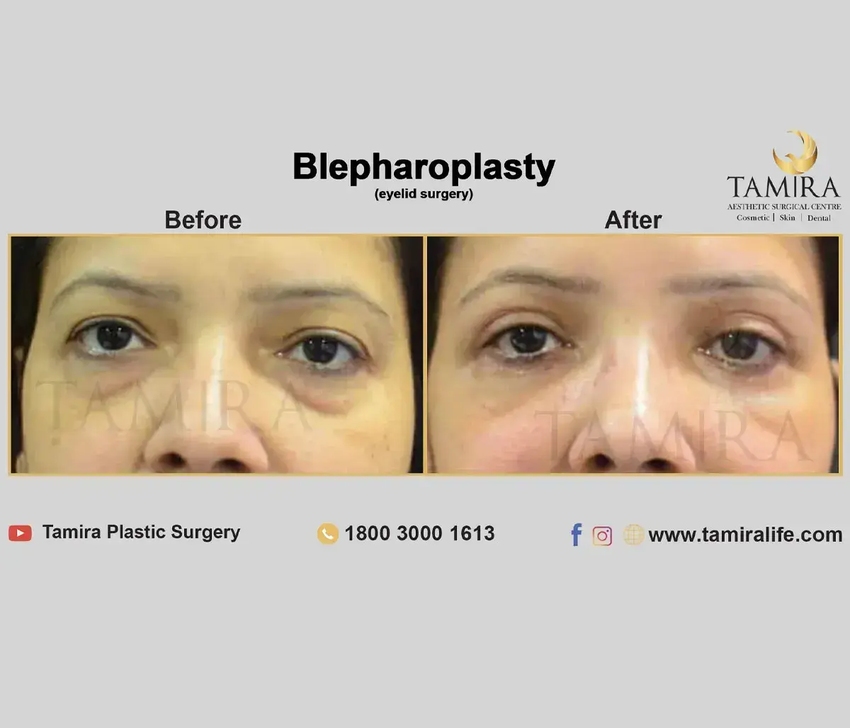 Upper eyelid blepharoplasty - Eye Brows - Before & After