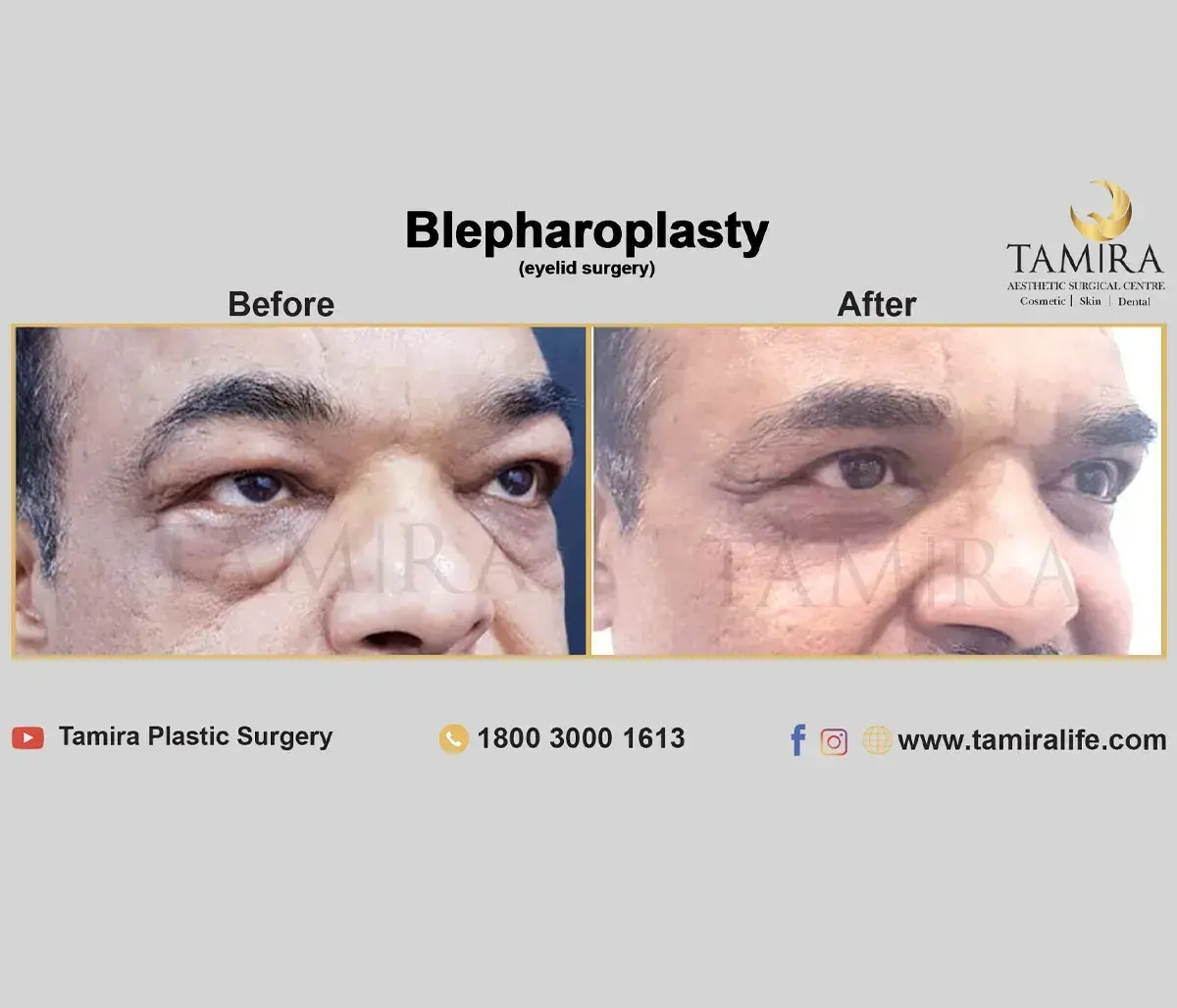 Lower eyelid Blepharoplasty - Eye Brows - Before & After