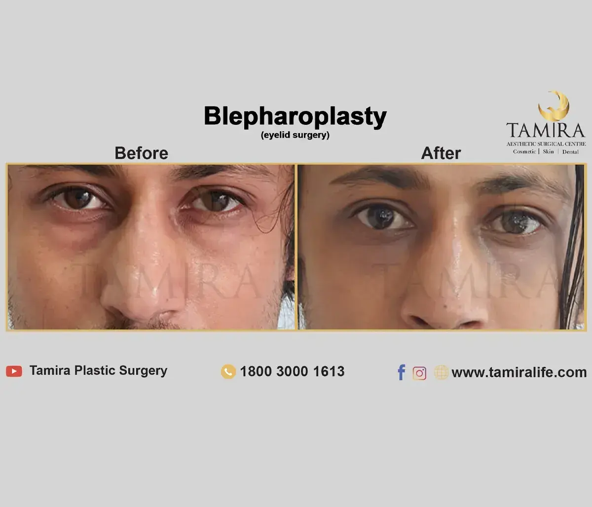 Lower eyelid Blepharoplasty - Eyelids - Before & After