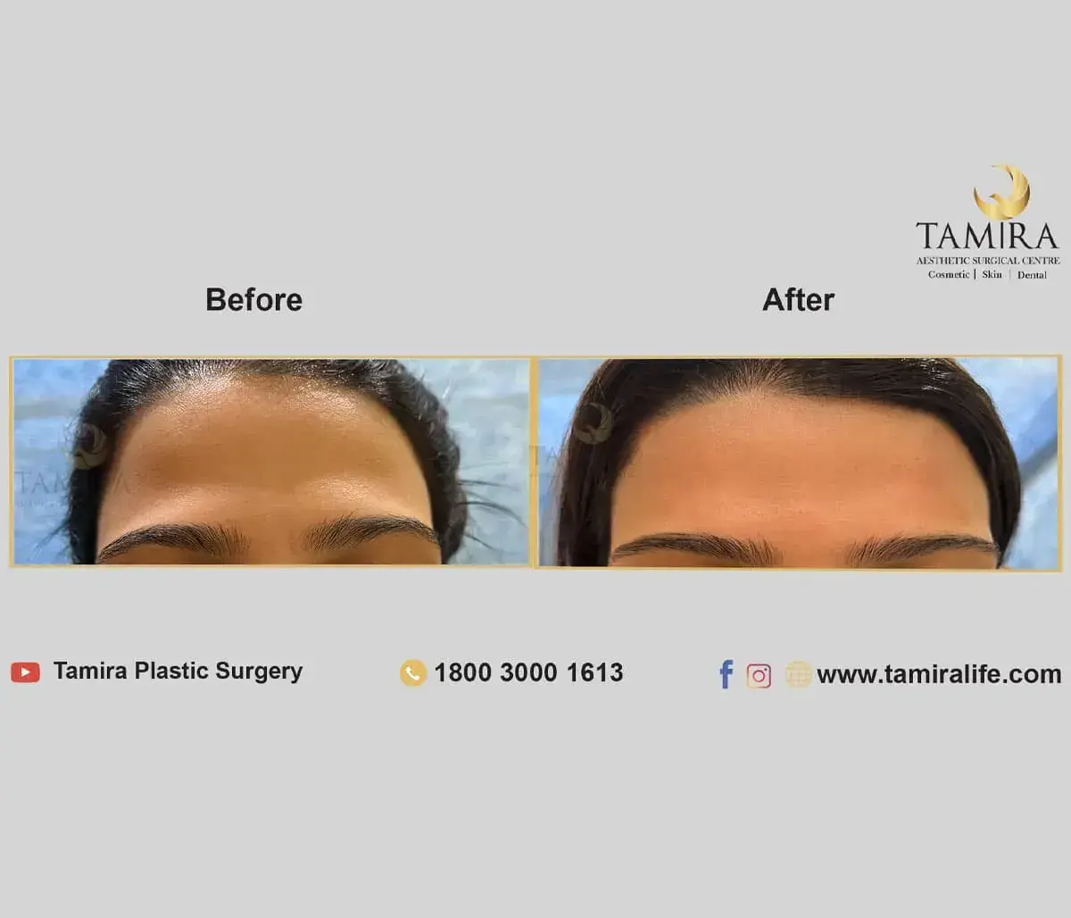 Injectables - Before & After