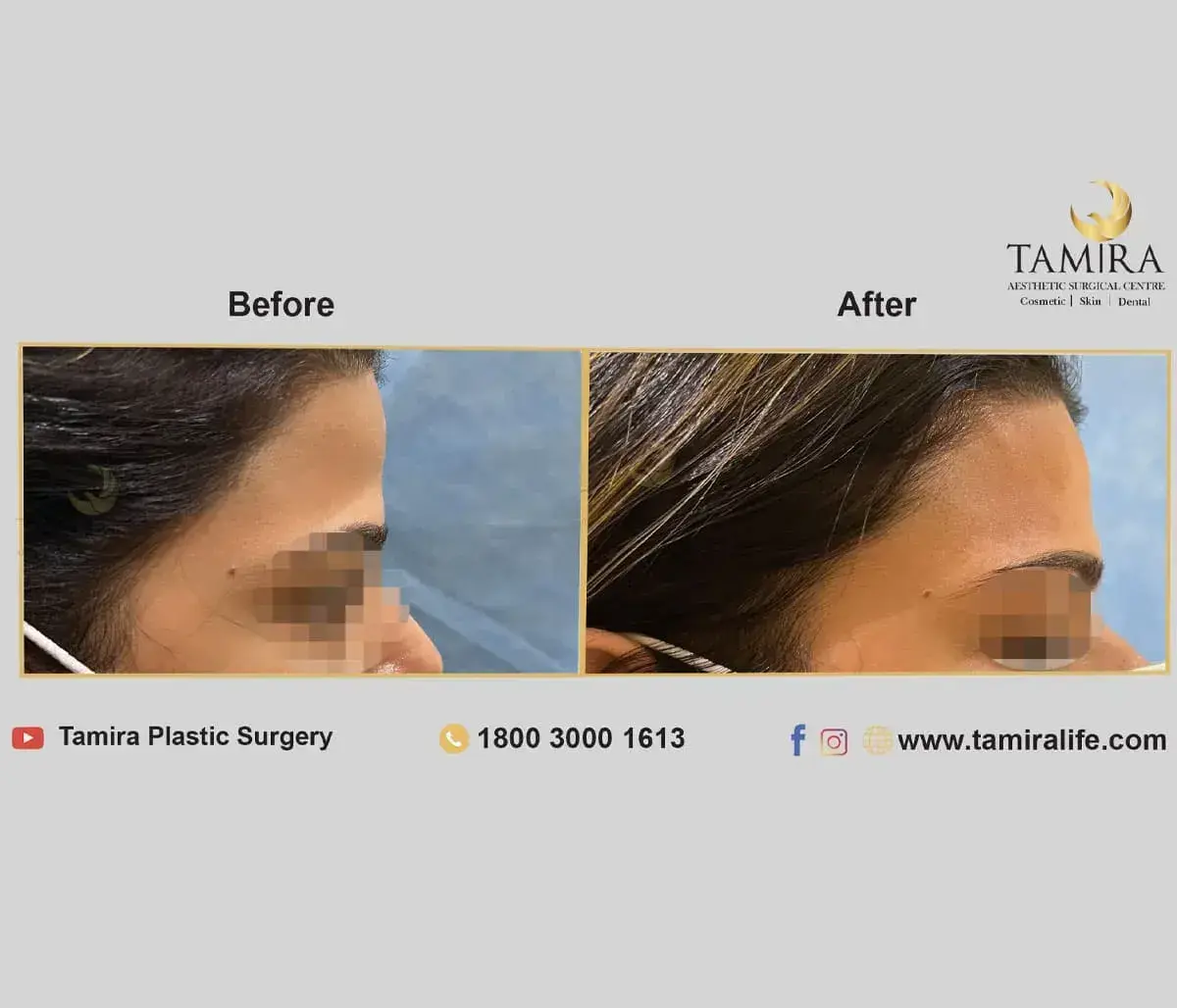 Injectables - Before & After