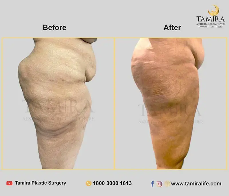 Liposuction - Thighs - Before & After
