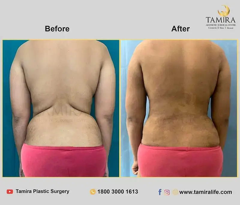 Liposuction - Flank/Sides - Before & After