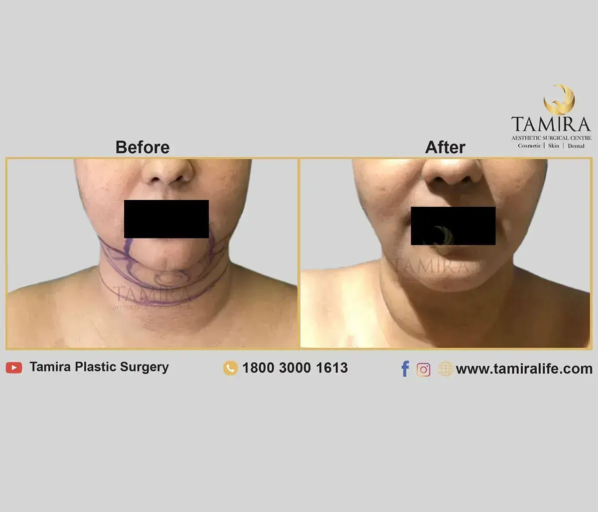Liposuction - Cheeks - Before & After