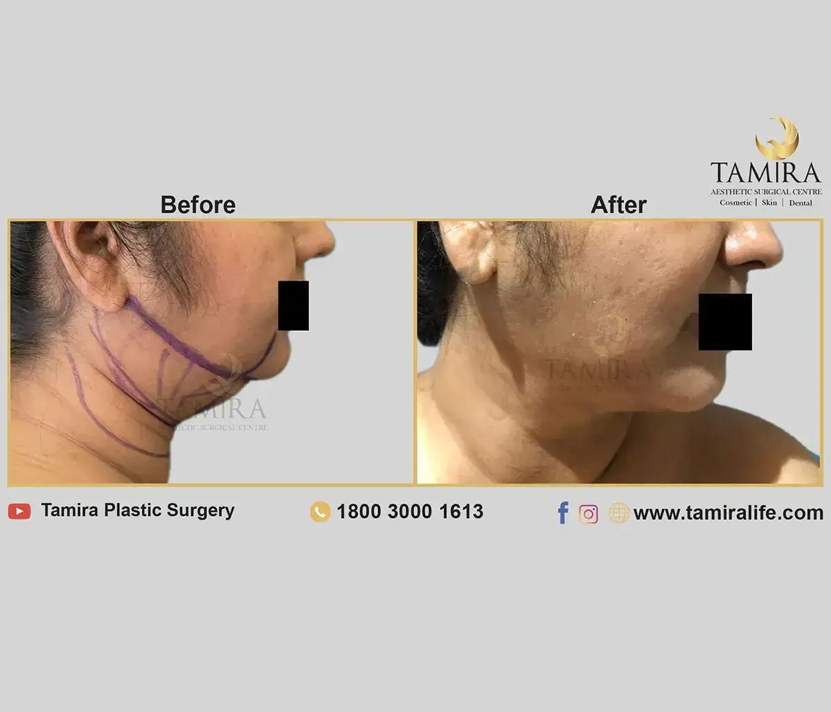 Liposuction - Cheeks - Before & After