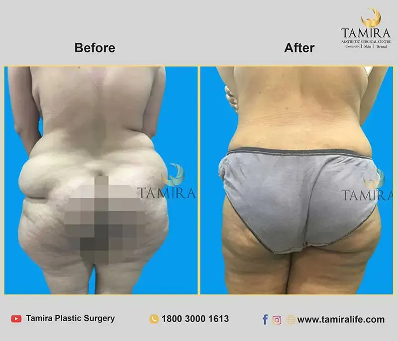Liposuction - Buttocks - Before & After