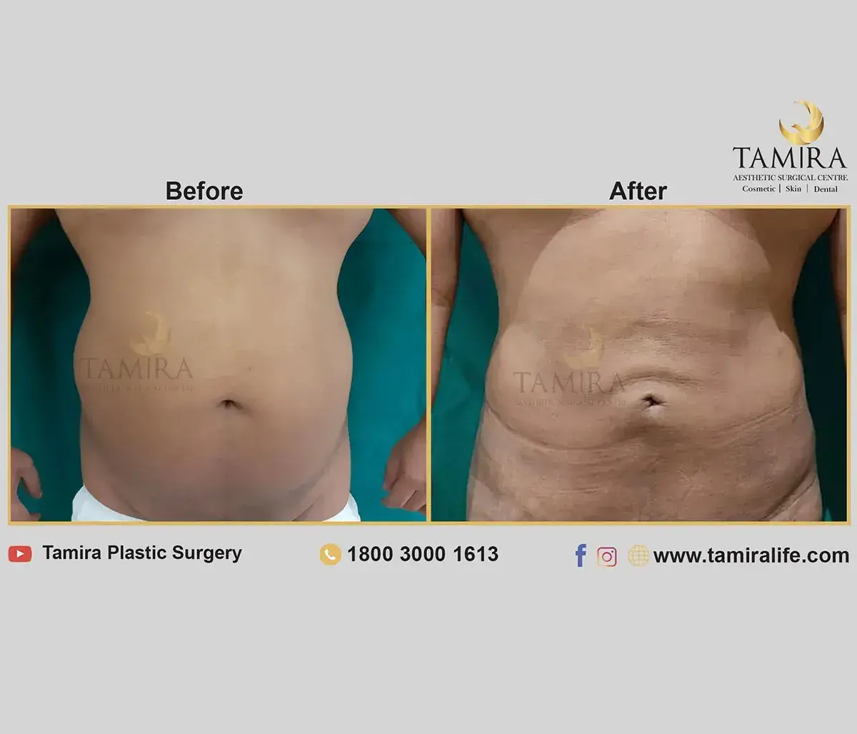 Liposuction - Abdomen - Before & After