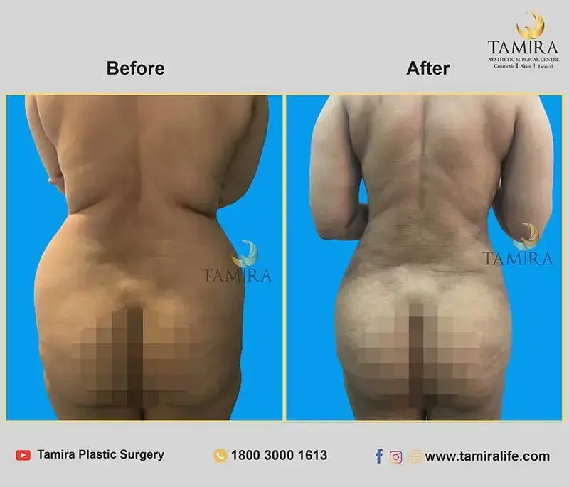 Liposuction - Buttocks - Before & After