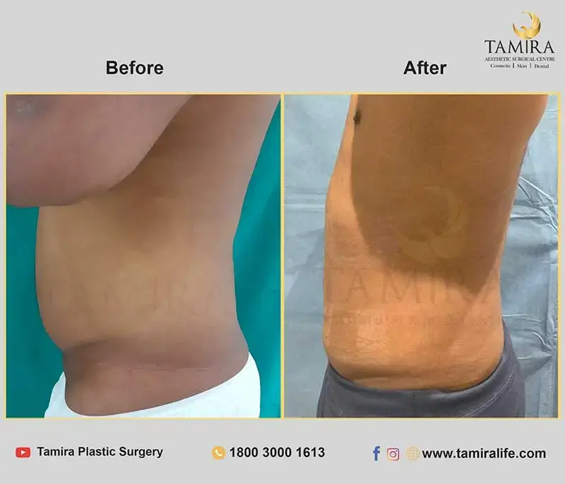 Liposuction - Abdomen - Before & After