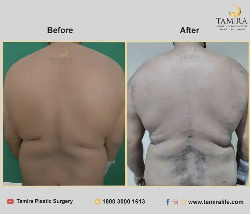 Liposuction with RF skin tightening - Abdomen - Before & After