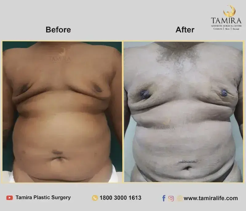 Liposuction with RF skin tightening - Abdomen - Before & After
