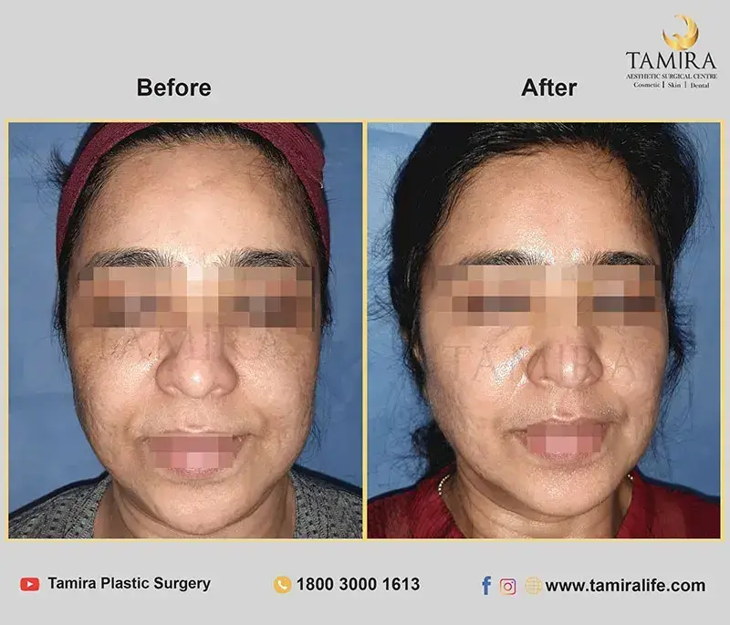 Chemical peels - Skin - Before & After