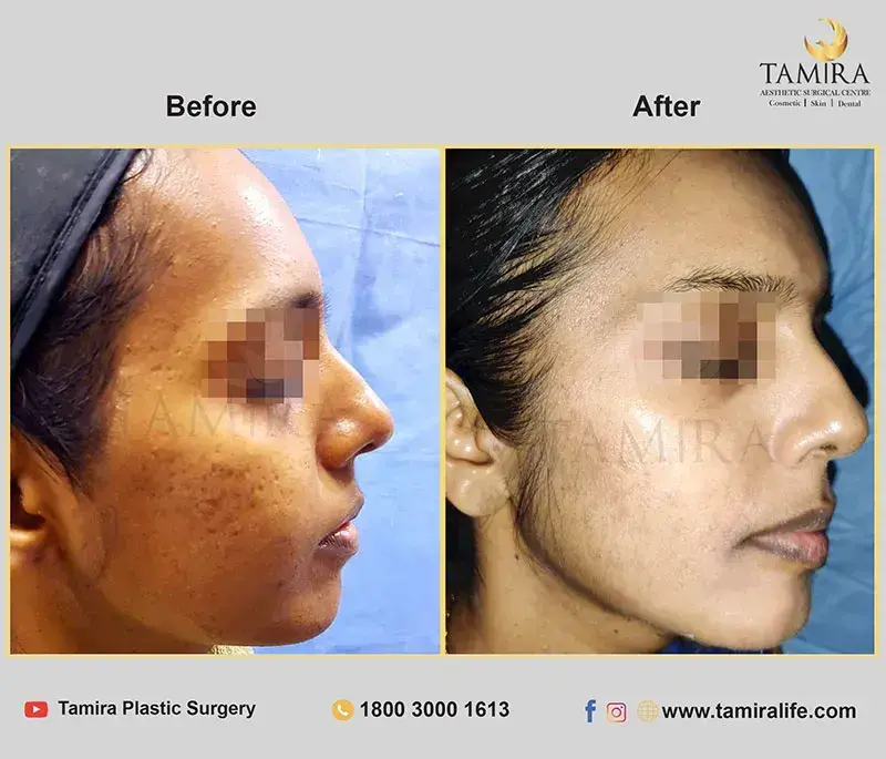 Chemical peels - Skin - Before & After
