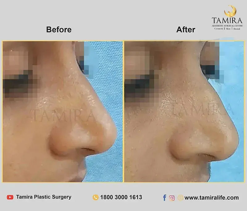 Nueromodulator injections (botox) - Before & After