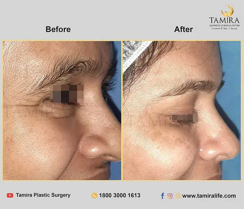Nueromodulator injections (botox) - Before & After
