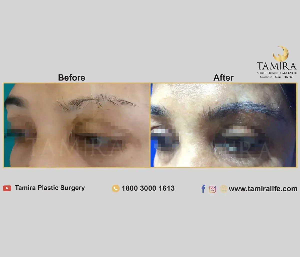 Eyebrow Hair Transplant - Eye Brows - Before & After