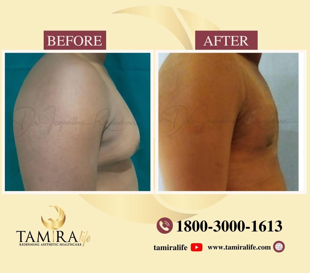 Gynecomastia Surgery - Before & After
