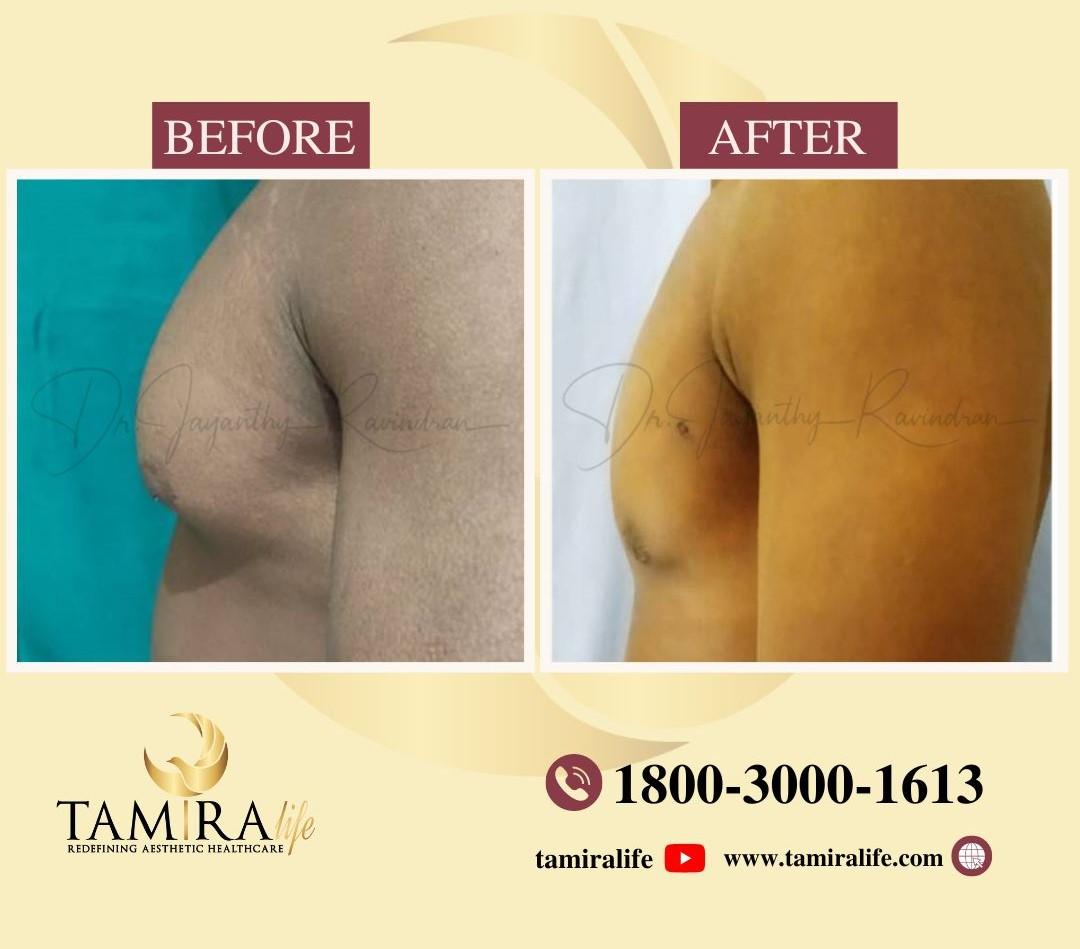 Gynecomastia Surgery - Before & After