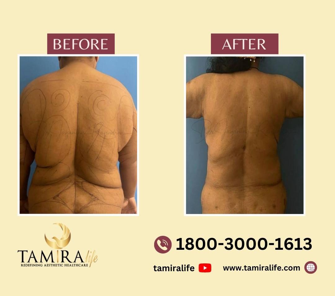 Liposuction Before After