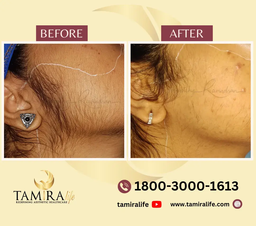 Face Laser Hair Removal Before After